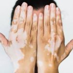 ENTRE 2 Y 6 POR CIENTO DE LOS MEXICANOS PADECE VITILIGO