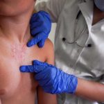 Añorve, alerta sobre aumento sin control de casos de sarampión en el país