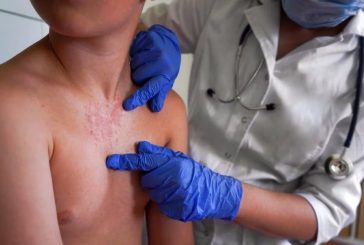 Añorve, alerta sobre aumento sin control de casos de sarampión en el país